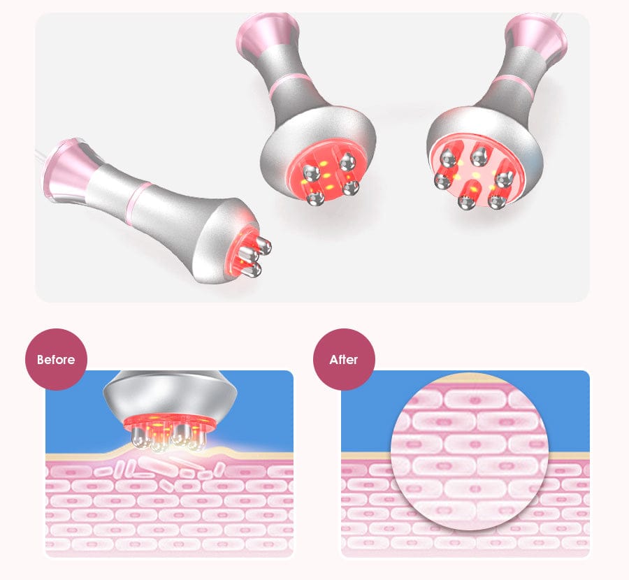 6-in-1 Body Contouring Device Featuring Ultrasonic Cavitation, RF, Vacuum Suction, and Laser for Effective Fat Reduction and Firm Skin