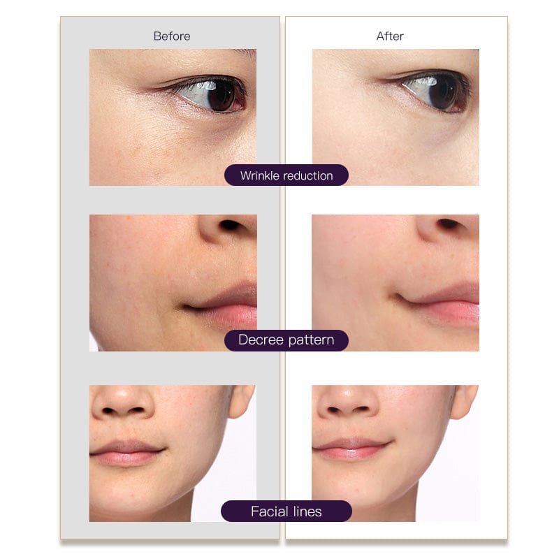 Bornbyme Facial Massager Radio Frequency Facial Machine 3 in 1 Light Therapy Anti- Aging Skin Tightening Rejuvenation