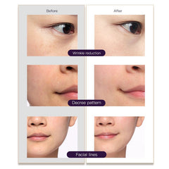 Bornbyme Facial Massager Radio Frequency Facial Machine 3 in 1 Light Therapy Anti- Aging Skin Tightening Rejuvenation